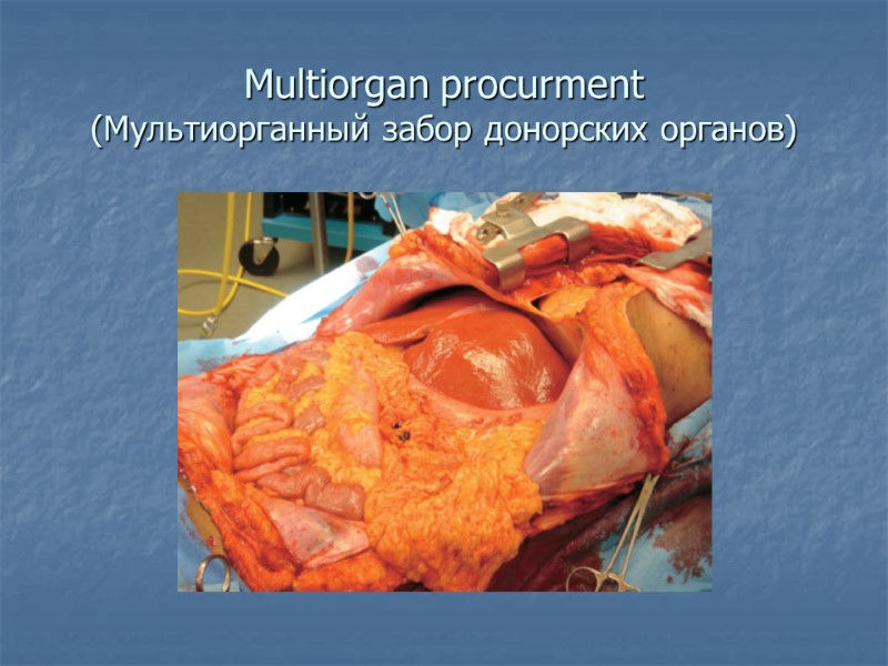 Multiorgan procurment (Мультиорганный забор донорских органов)
